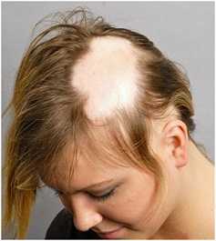 Little Mixs Jessy suffered from Alopecia Areata caused by bullying