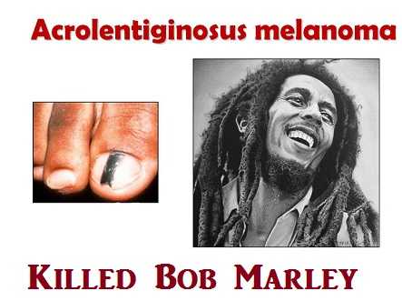 Bob Marley died of foot cancer of melanoma