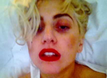 Lady Gaga took months to recover from the pole on face freakish live performance accident.