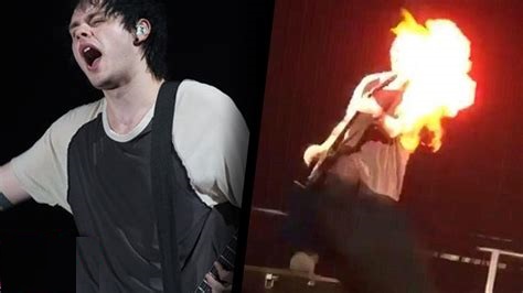 Michael Clifford's hair and face were severely burned from an on stage fire.