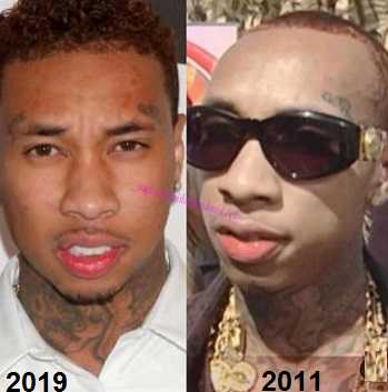 Tyga was going bald before he had a hair transplant