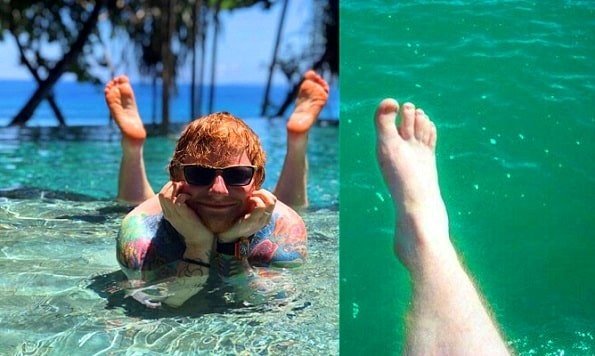Ed Sheeran hurt his feet badly in an  accident