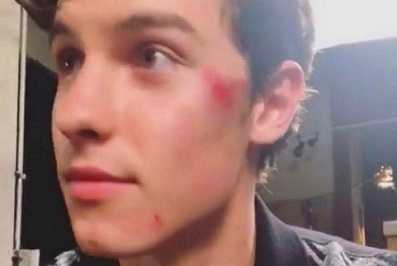 Shawn Mendes bruised his face from a soccer game